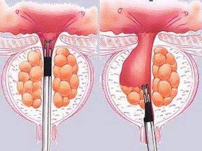 前列腺增生的那些事